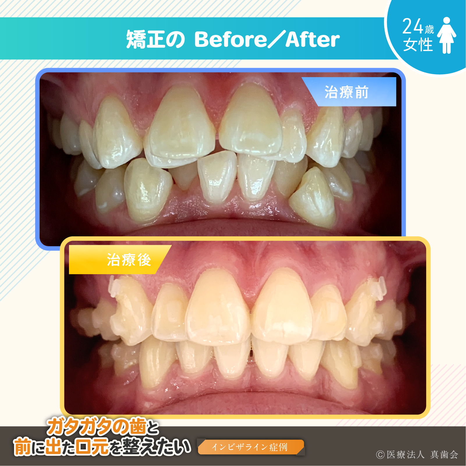 矯正の Before／After