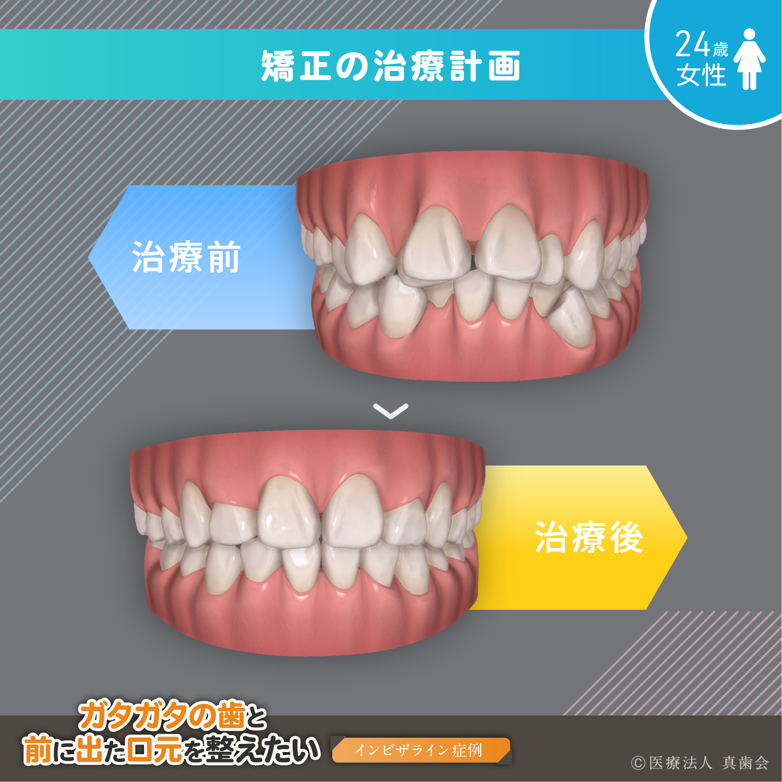 矯正の治療計画