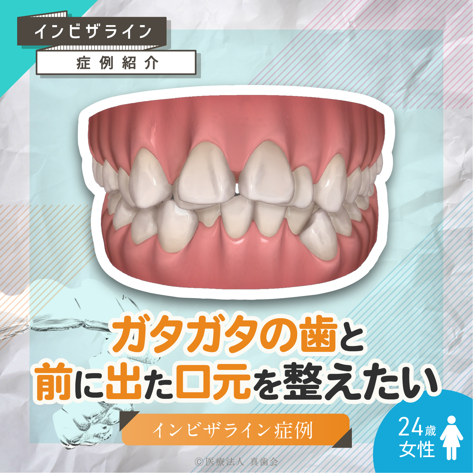 ガタガタの歯と?前に出た口元を整えたい