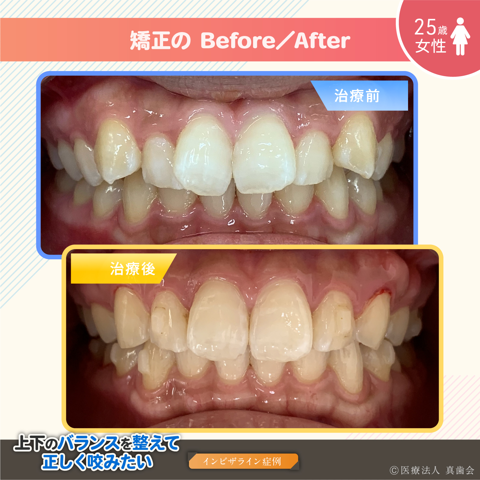 矯正の Before/After