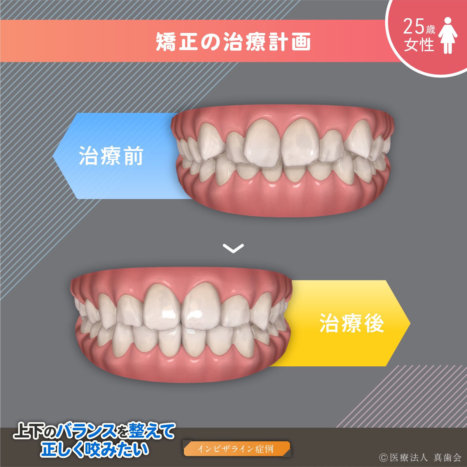矯正の治療計画