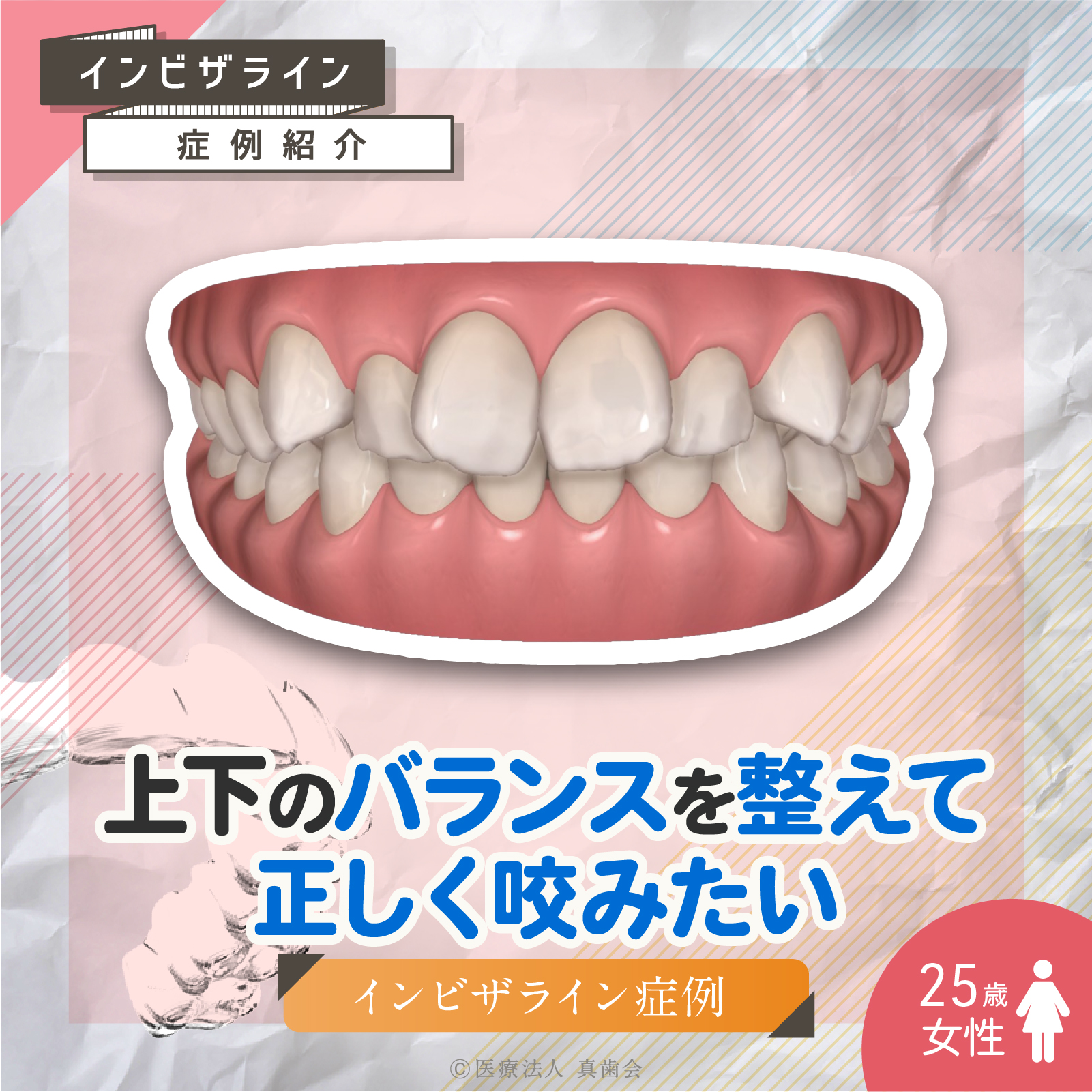 上下のバランスを整えて正しく咬みたい